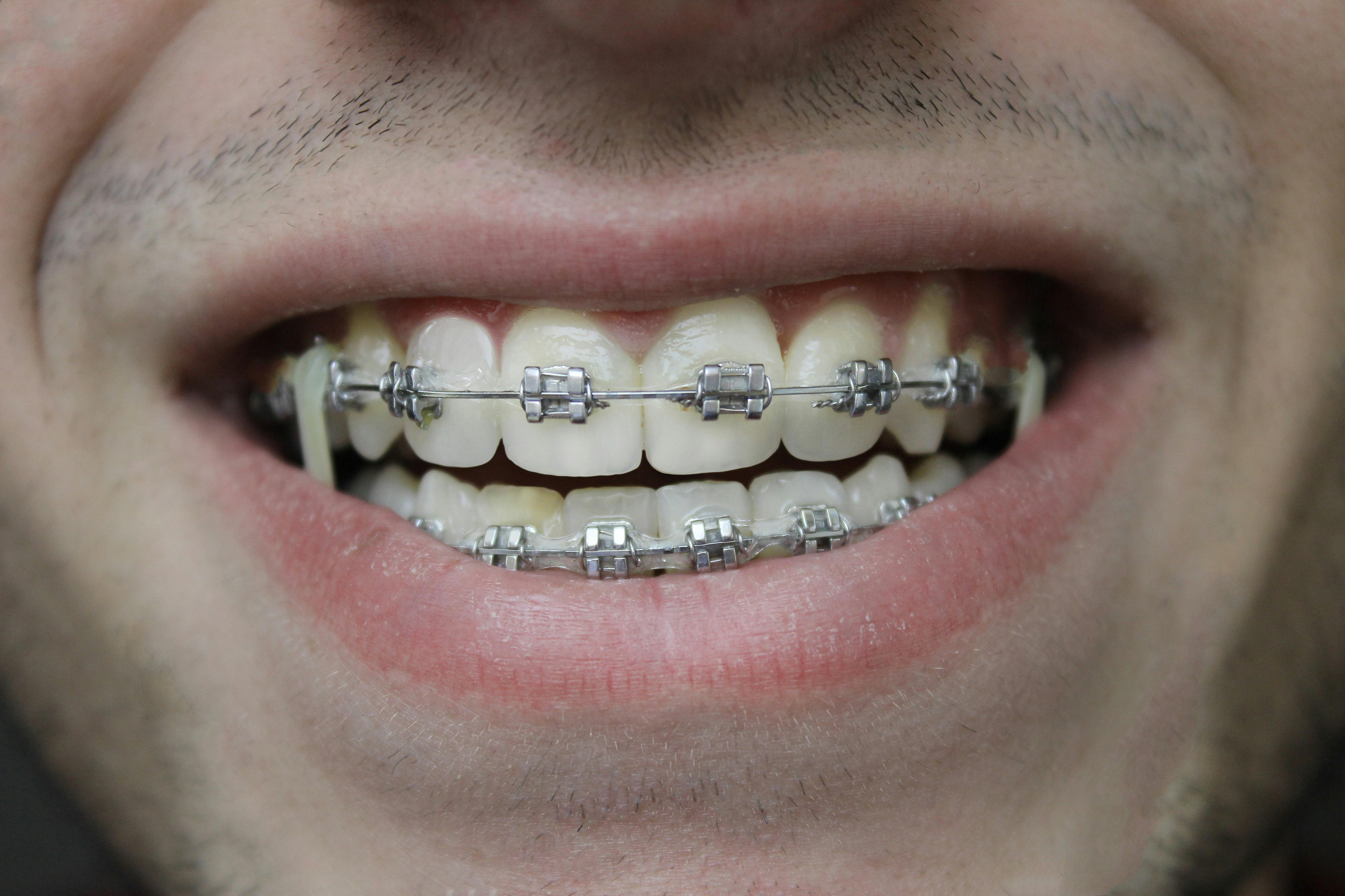 Orthodontie behandeling Rotterdam